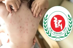  সিলেটে হামের উপসর্গে আরও ২ শিশুর মৃত্যু